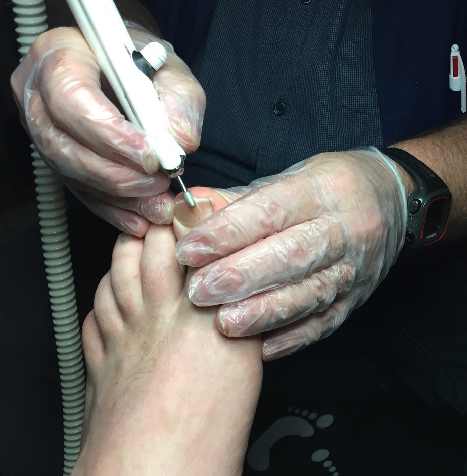 Thick nail treatment