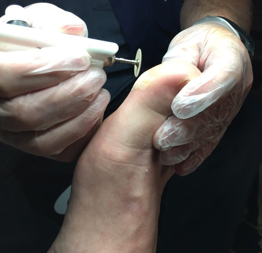 Callus filing with abrasive disc