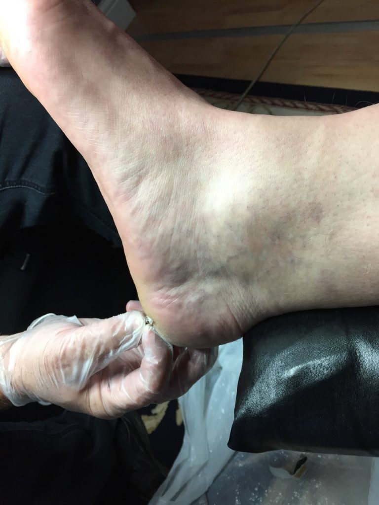 Hard skin removal with scalpel