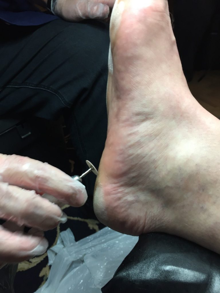 Hard skin filing with an abrasive disc